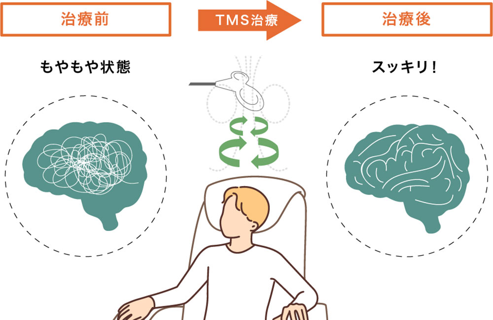 TMS治療（経頭蓋磁気刺激）とは？